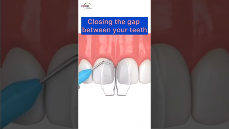 Closing Teeth gaps with Composite Filling #process #teethgap #teeth Closing Teeth gaps with Composite Filling #process #teethgap #teeth